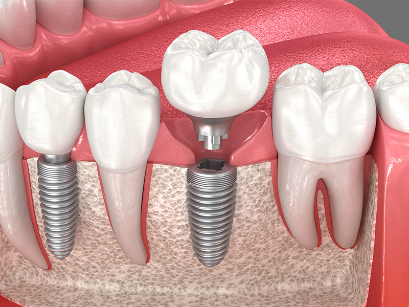 3D-Darstellung eines Zahnimplantats im Kieferknochen mit eingesetzter Krone zeigt präzisen Aufbau moderner implantologischer Versorgung